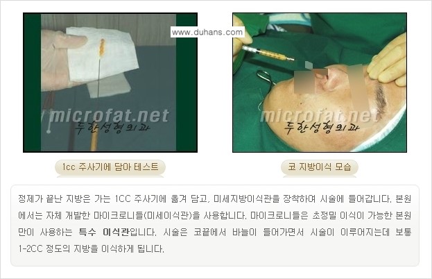 [두한성형외과 경쟁력 미세지방이식] - [미세지방이식을 이용한 코성형의 장점 안내] 관련 이미지 6