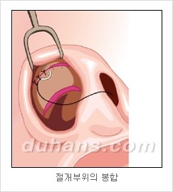 DuHan Plastic Surgery Revision Rhinoplasty - AlloDerm Nose Surgery, SureDerm Nose Surgery image 12