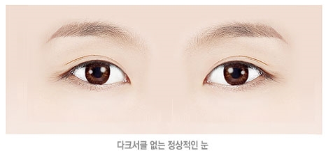 두한성형외과 눈밑수술 - 다크서클 수술 전후 관리 안내 관련 이미지 100