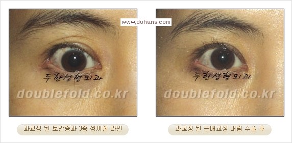 [두한성형외과 경쟁력 쌍꺼풀 재수술, 극한 재수술] - [쌍꺼풀 재수술에서 극복해야 할 극한의 상황과 문제들] 관련 이미지 18