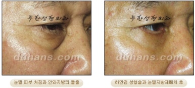 Blepharoplasty, Duhan Plastic Surgery - Upper and Lower Eyelids image 46