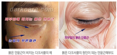 Duhan Plastic Surgery Dark Circle Improvement - What Causes Dark Circles? What Types of Dark Circles Are There? image 2