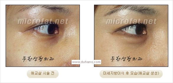 [두한성형외과 경쟁력 눈밑성형] - [타 병원 필러 애교살 시술 부작용을 미세지방이식으로 교정] 관련 이미지 33