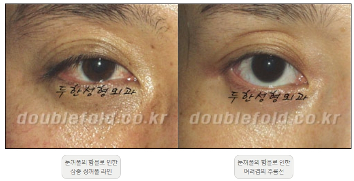 [Double Eyelid Surgery Duhan Plastic Surgery] - [Revision Methods] image 26