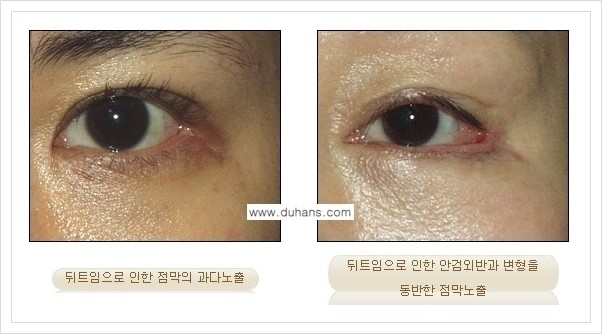 [두한성형외과 경쟁력 있는 쌍꺼풀 재수술] - [뒤트임 수술] 관련 이미지 4