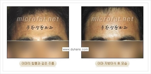 [두한성형외과 경쟁력 미세지방이식] - [부드럽고 아름다운 얼굴 윤곽선 이마(전두부) 미세지방이식] 관련 이미지 8