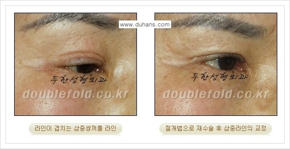 [두한성형외과 경쟁력 쌍꺼풀 재수술] - [삼중 쌍꺼풀 라인의 교정 안내] 관련 이미지 8
