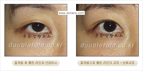 [두한성형외과 NO.1 경쟁력 눈성형] - [풀린 쌍꺼풀 절개법으로 교정하는 방법] 관련 이미지 2