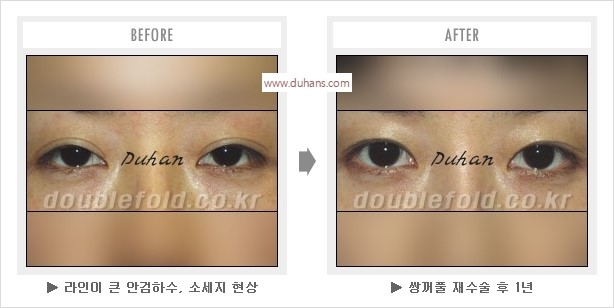 [두한성형외과 경쟁력 눈성형] - [나에게 맞는 어울리는 쌍꺼풀 라인] 관련 이미지 17