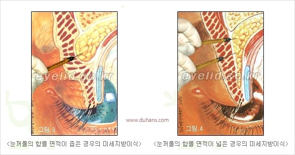 [두한성형외과 경쟁력 안검성형] - [꺼진 눈꺼풀, 눈꺼풀 함몰, 윗눈꺼풀 미세지방이식] 관련 이미지 4