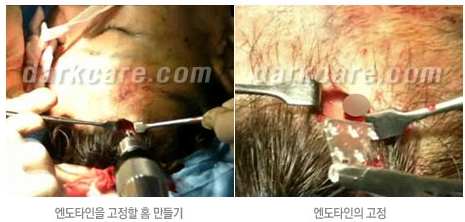 Duhan Plastic Surgery Combo Program - Dark Circles and Lifting image 23