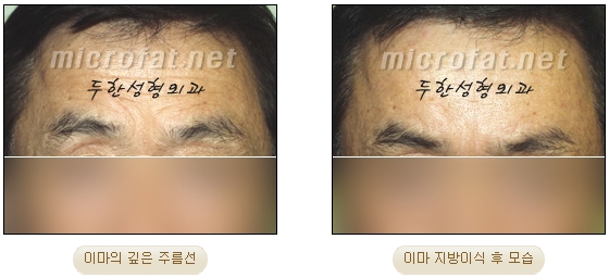 [두한성형외과 이마성형] - [엔도타인리프팅, 이마지방이식]​ 관련 이미지 30