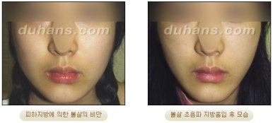 [두한성형외과 안전한 지방흡입] - [얼굴지방흡입] 관련 이미지 34