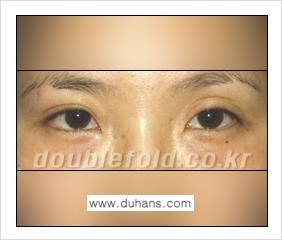 [두한성형외과 경쟁력 쌍꺼풀 재수술] - [쌍꺼풀 재수술의 대상과 해당 쌍꺼풀 재수술 방법 안내] 관련 이미지 6