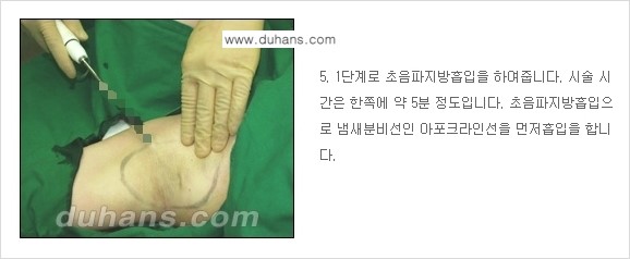[두한성형외과 성형 FOCUS 지방흡입] - [액취증 - 다한증 초음파 컷터 지방흡입 ④] 관련 이미지 6
