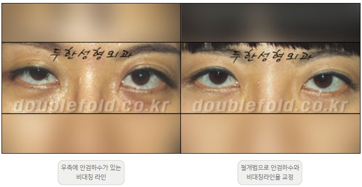 [Ptosis, Duhan Plastic Surgery] - [Sleepy-Looking Eyes, Ptosis Eye Correction] image 17