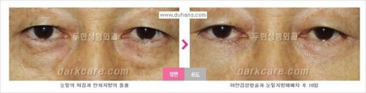 [두한성형외과 경쟁력 눈밑성형] - [Dr. 컬럼 "눈밑 지방재배치의 문제점"] 관련 이미지 7