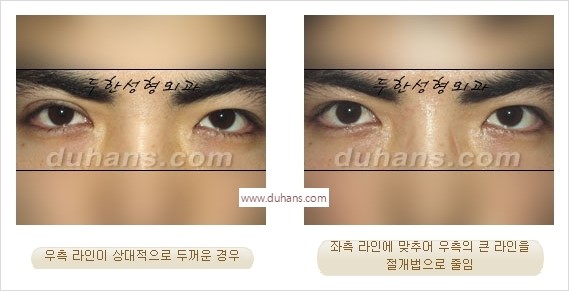 [두한성형외과 경쟁력 눈성형] - [나에게 맞는 어울리는 쌍꺼풀 라인] 관련 이미지 29