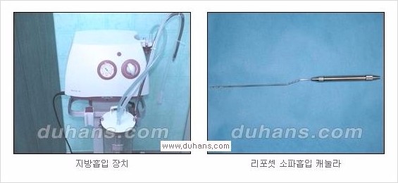 ​[두한성형외과 경쟁력 다한증 치료] - [참기 힘든 땀의 해결! 겨드랑이 다한증의 리포셋 소파흡입술] 관련 이미지 1