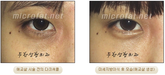Duhan Plastic Surgery Under-Eye Surgery - Correction with Fat Grafting After Aegyo-Sal Filler image 19