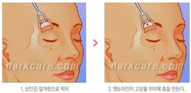 [눈밑수술 두한성형외과] - [다크서클 콤비프로그램] 관련 이미지 147