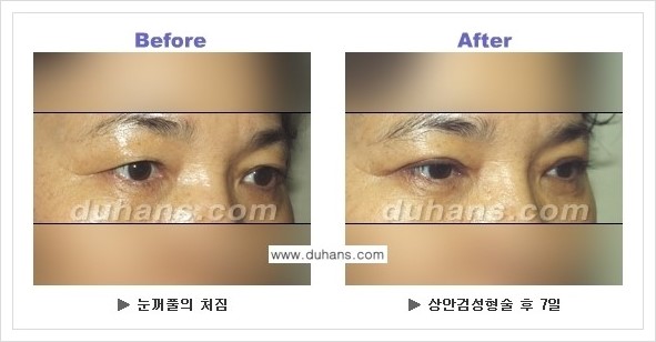 [두한성형외과 경쟁력 눈성형] - [상큼하고 환한 젊은 눈매 상안검성형(윗눈꺼풀 처짐) 안내] 관련 이미지 11