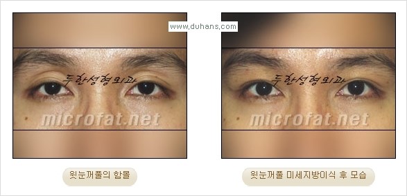 [두한성형외과 경쟁력 미세 #지방이식 ] - [윗 #눈꺼풀함몰, #꺼진눈꺼풀, #눈위지방이식, #눈위함몰] 관련 이미지 23