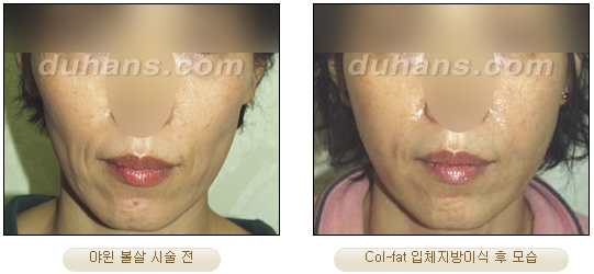 [Duhan Plastic Surgery Facial Autologous Fat Grafting] - [Fat Grafting Guide] image 31