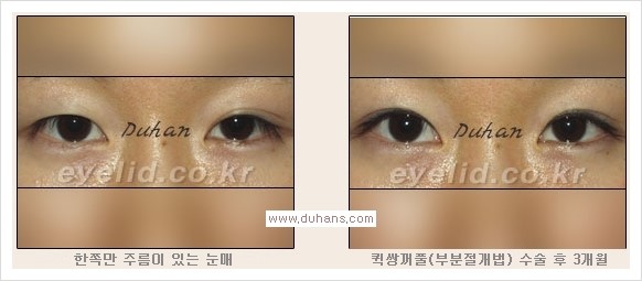 [두한성형외과 경쟁력 눈성형, 쌍꺼풀 수술] - [퀵쌍꺼풀(부분절개법)의 수술 안내] 관련 이미지 15