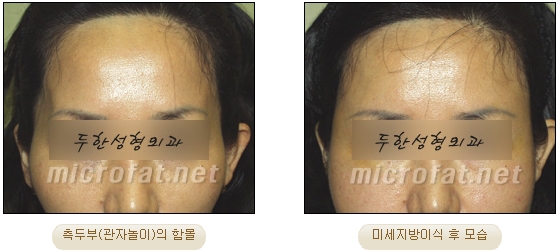 [두한성형외과 자가지방이식] - [관자놀이 교정] 관련 이미지 8