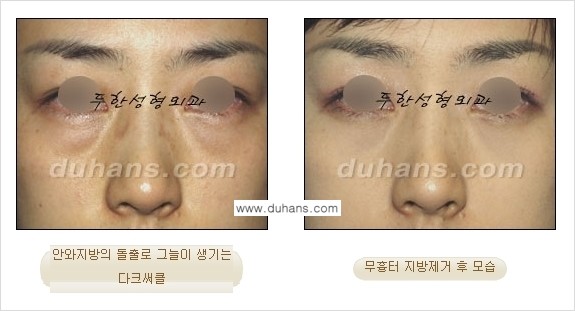 [두한성형외과 젊은 눈매 안검성형] - [눈밑 지방제거의 수술 전후 안내 ②] 관련 이미지 16
