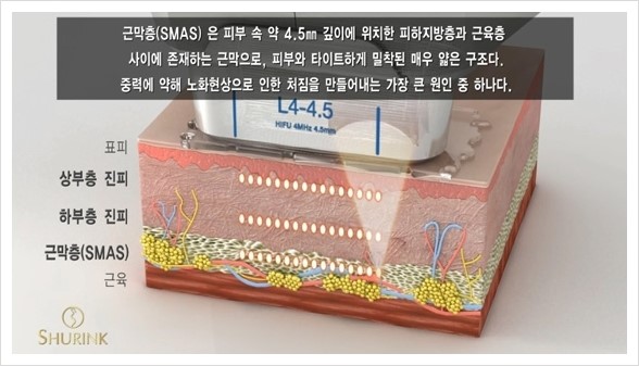 [두한성형외과 경쟁력 주름성형] - [주름제거를 위한 리프팅] 관련 이미지 39