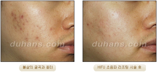 [Duhan Plastic Surgery Lift] - [Double Chin, Drooping Cheeks, Sagging Neck Skin, Wrinkle Improvement] image 22
