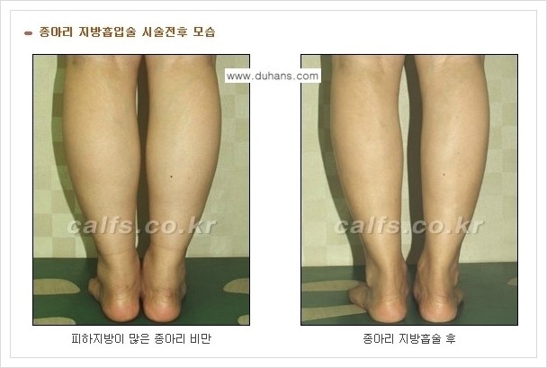[두한성형외과 경쟁력 멀티종아리성형] - [매력적인 종아리를 만드는 종아리 지방흡입술 안내 2.] 관련 이미지 1