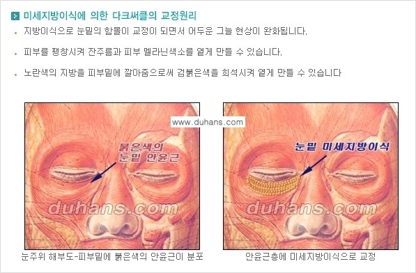 [두한성형외과 경쟁력 미세지방이식] - [다크써클 & 눈밑주름 미세지방이식 1.] 관련 이미지 6