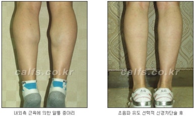 ​[두한성형외과 종아리수술] - [나에게 맞는 종아리성형방법] 관련 이미지 15