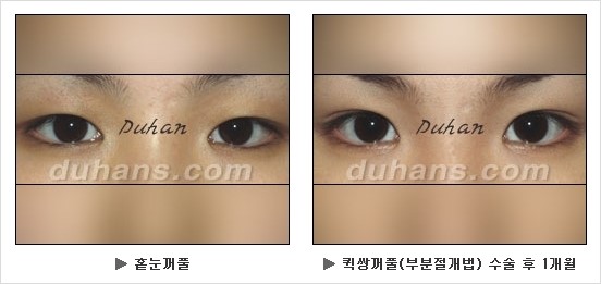 [두한성형외과 쌍커풀수술] - [눈성형 방법에 대한 자주하는 질문과 답변] 관련 이미지 126