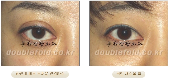 [DoubleFold Plastic Surgery Eye Surgery] - [Revision Surgery for Thick Double Eyelids] image 42