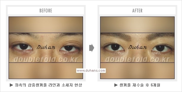 ⁠[두한성형외과 경쟁력 쌍꺼풀 재수술, 극한 눈재수술] - [삼중(세겹) 쌍꺼풀 라인의 교정] 관련 이미지 2
