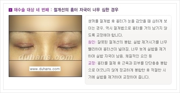 [두한성형외과 경쟁력 쌍꺼풀 재수술(극한 재수술)] - [쌍꺼풀 재수술 대상의 안내] 관련 이미지 4