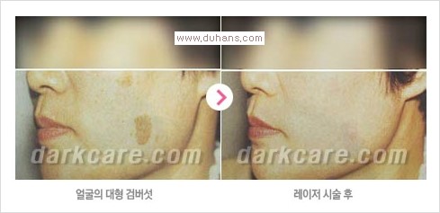 [두한성형외과 경쟁력 눈밑성형] - [다크써클 + 검버섯 레이저 콤비 프로그램 안내] 관련 이미지 12