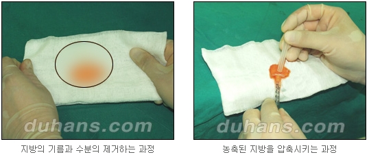 [두한성형외과 주름개선] - [주름교정 방법] 관련 이미지 50