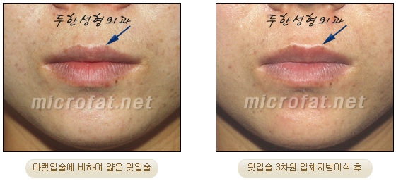 [Duhan Plastic Surgery Lip Surgery] - [Lip Correction Fat Grafting] image 12