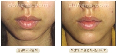 [Duhan Plastic Surgery Micro Fat Grafting] - [Receded Chin, Small Chin, Cleft Chin, Chin Line Asymmetry Correction] image 12