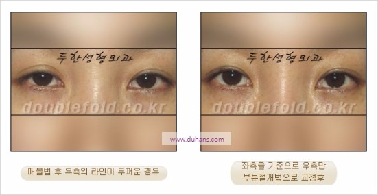 [두한성형외과 경쟁력 눈성형] - [비대칭 쌍꺼풀 라인의 여러 가지 교정 방법] 관련 이미지 3