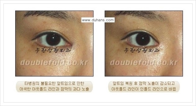 [두한성형외과 경쟁력 쌍꺼풀 재수술, 극한 눈재수술)] - [과도한 앞트임이 되었을 경우 교정 방법 안내] 관련 이미지 1