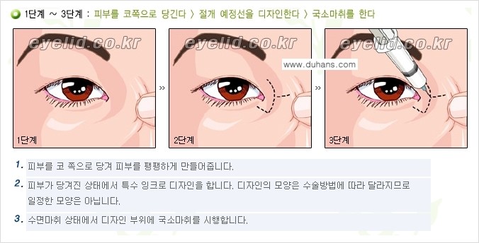 [두한성형외과 눈성형 FOCUS] - [몽고주름 제거(앞트임 제거) 수술 ③] 관련 이미지 8