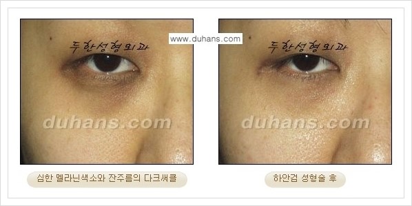 [두한성형외과 경쟁력 눈성형] - [젊은 눈매로의 복원 안검성형] 관련 이미지 36