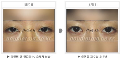 두한성형외과 쌍커풀 재수술 - 짝눈 눈매교정, 가성 안검하수 교정과 뒤밑트임 관련 이미지 45