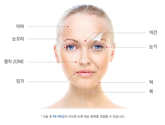 두한성형외과 주름개선 - 주름 HIFU 리프팅 관련 이미지 4